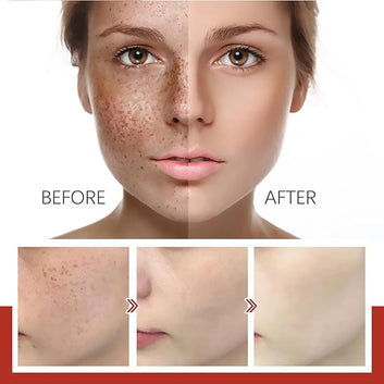 Eelhoe™ Pigment Correcting Cream-لإزالة البقع الداكنة والتصبغات