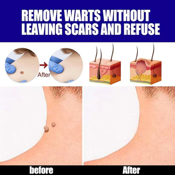 Dermacure™ Warts Treatment Cream-كريم علاج الثآليل